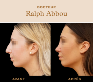 Rhinoplastie ultrasonique