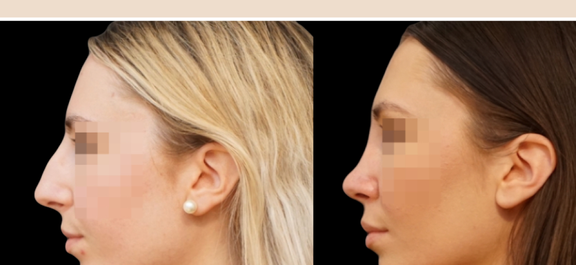 Rhinoplastie ultrasonique