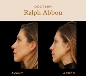 Rhinoplastie ultrasonique