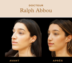 Rhinoplastie ultrasonique