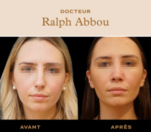 Rhinoplastie ultrasonique