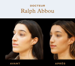 Ultrasonic rhinoplasty