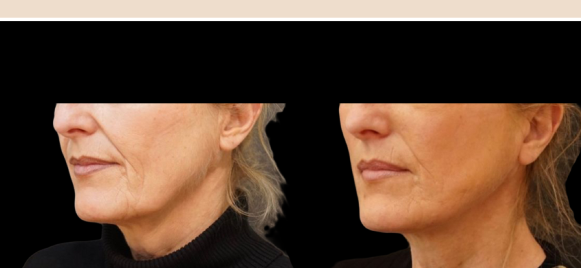 fils tenseurs visage Paris