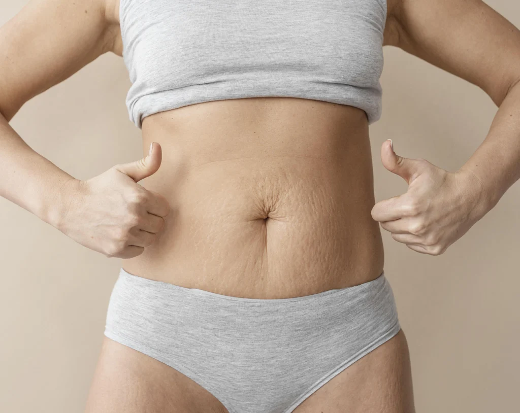 Diastasis abdominal