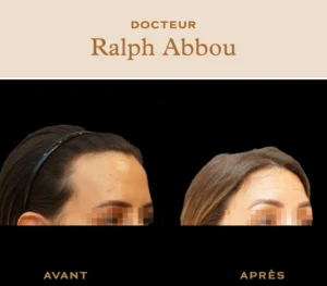 féminisation visage