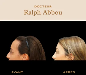 féminisation visage