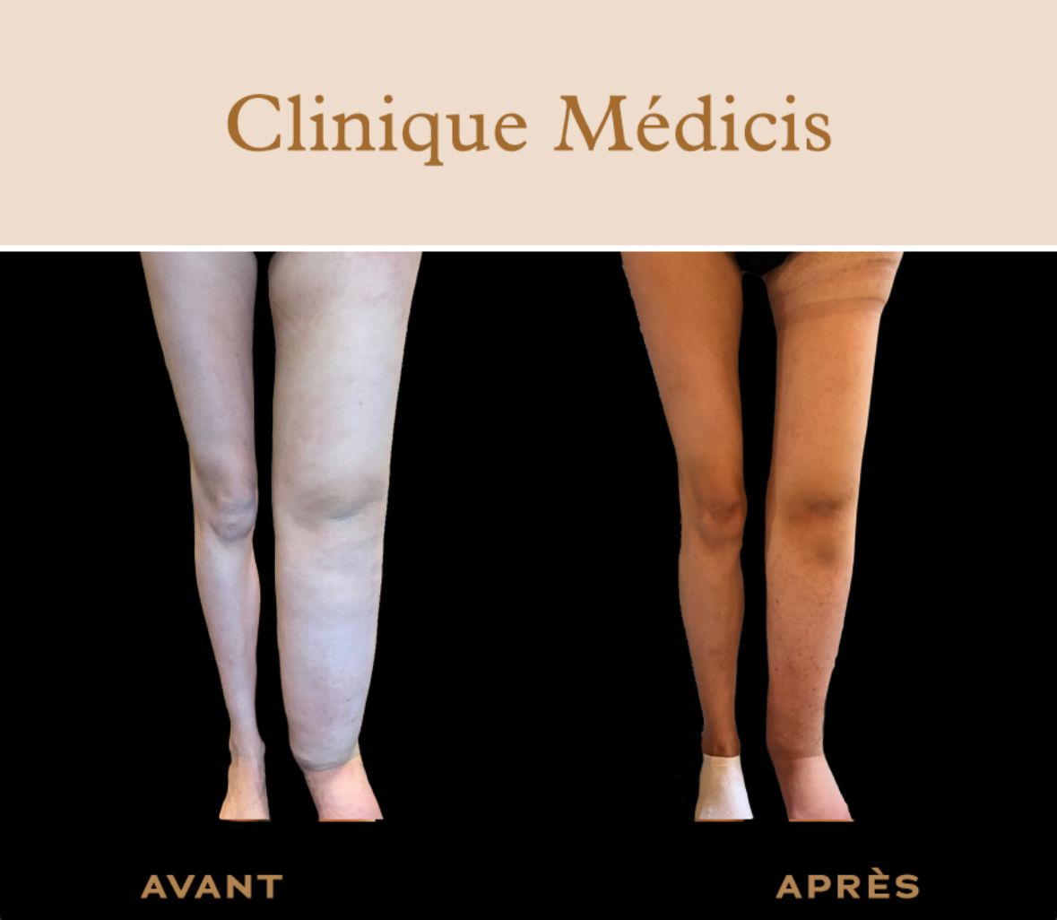 Lymphoedème paris