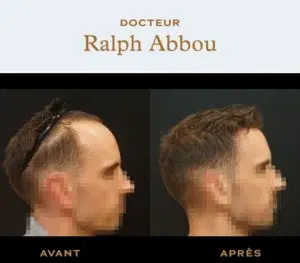 forehead reduction paris