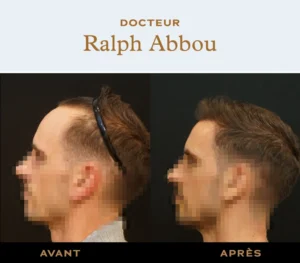 forehead reduction paris