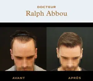 forehead reduction paris