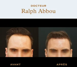 forehead reduction paris