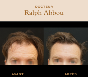 Greffe de cheveux paris