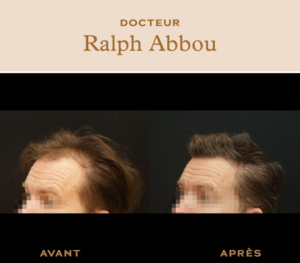 Greffe de cheveux paris