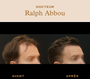 Greffe de cheveux paris