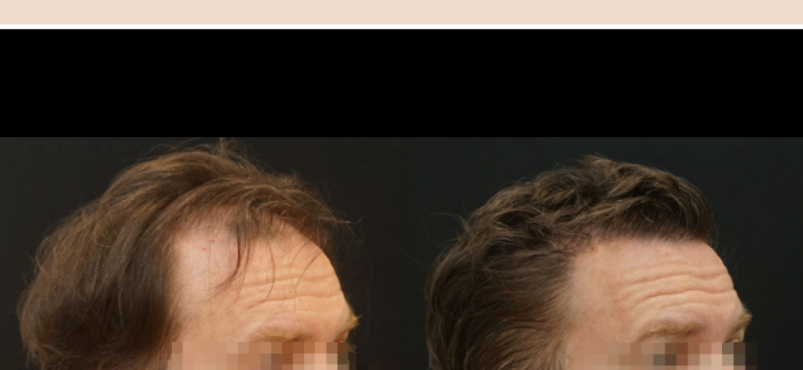 Greffe de cheveux paris