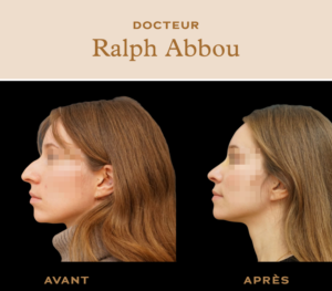 Rhinoplastie ultrasonique