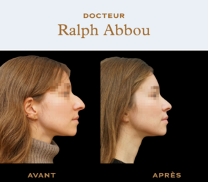 Ultrasonic rhinoplasty paris