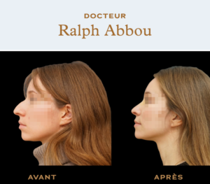 Ultrasonic rhinoplasty paris
