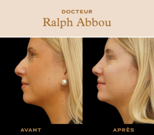 rhinoplastie ultrasonique paris