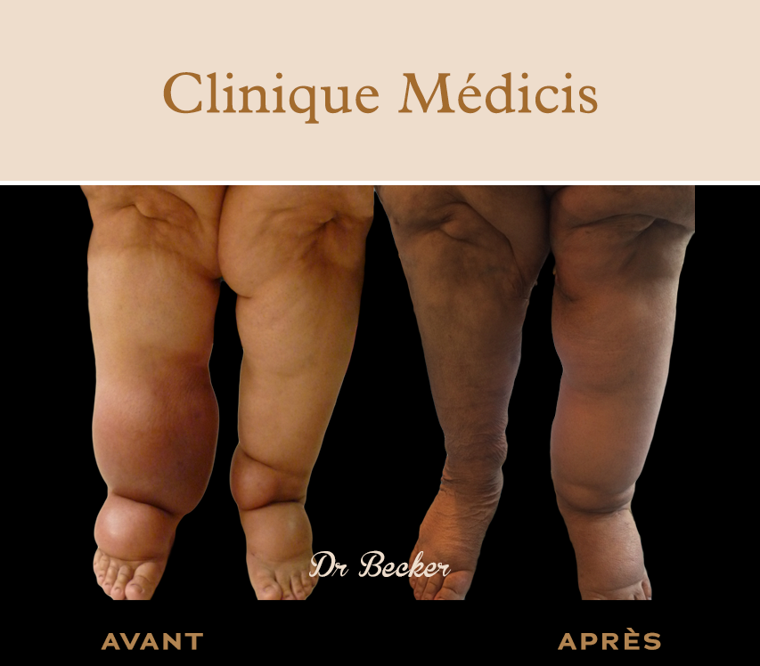 Traitement lymphœdème paris