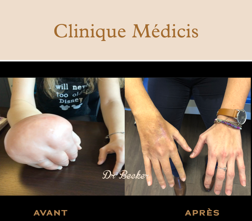 Traitement lymphœdème paris