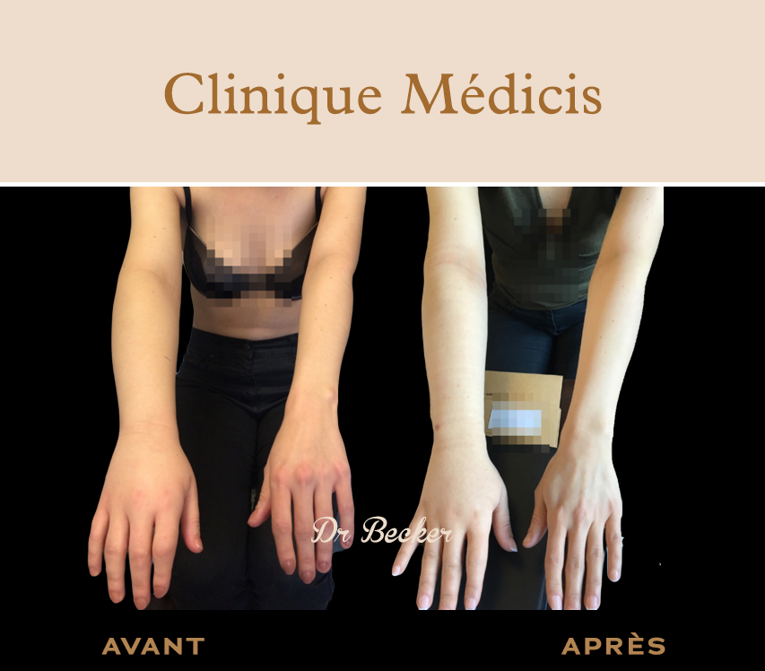 Traitement lymphœdème paris