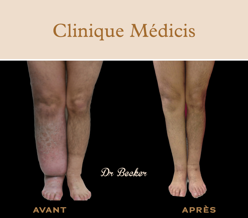 Traitement lymphœdème paris
