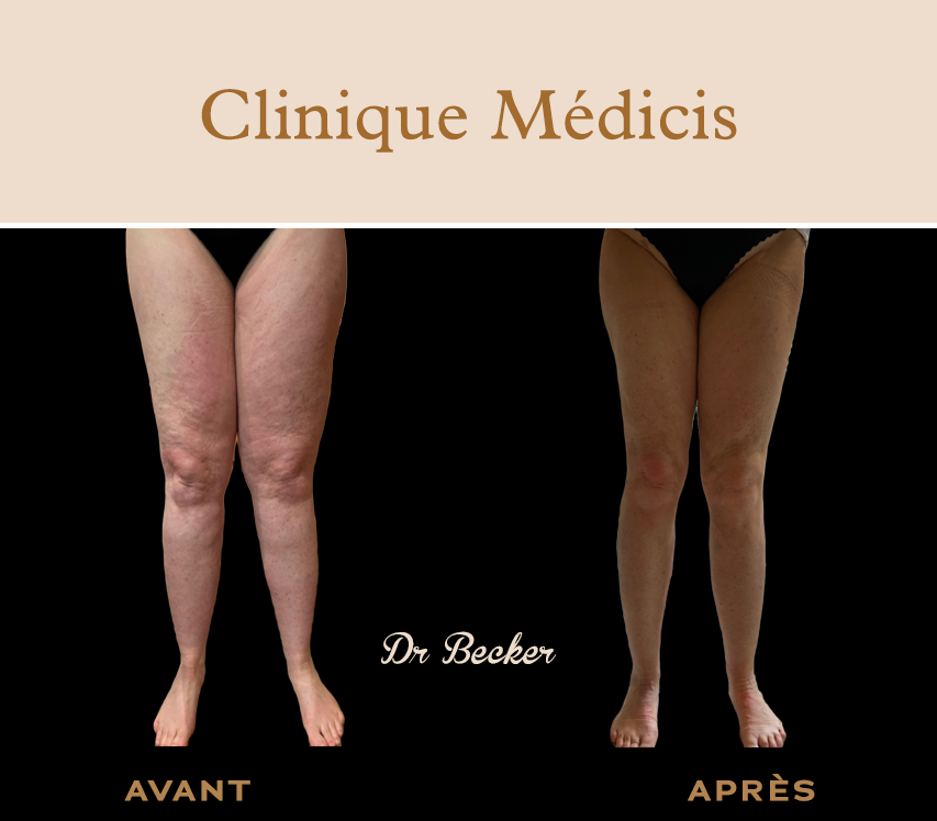 Traitement lymphœdème paris