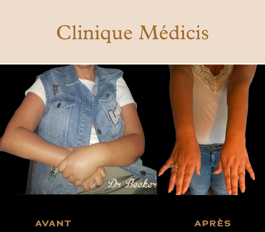 Traitement lymphœdème paris