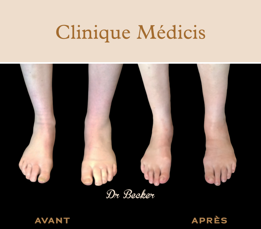 Traitement lymphœdème paris