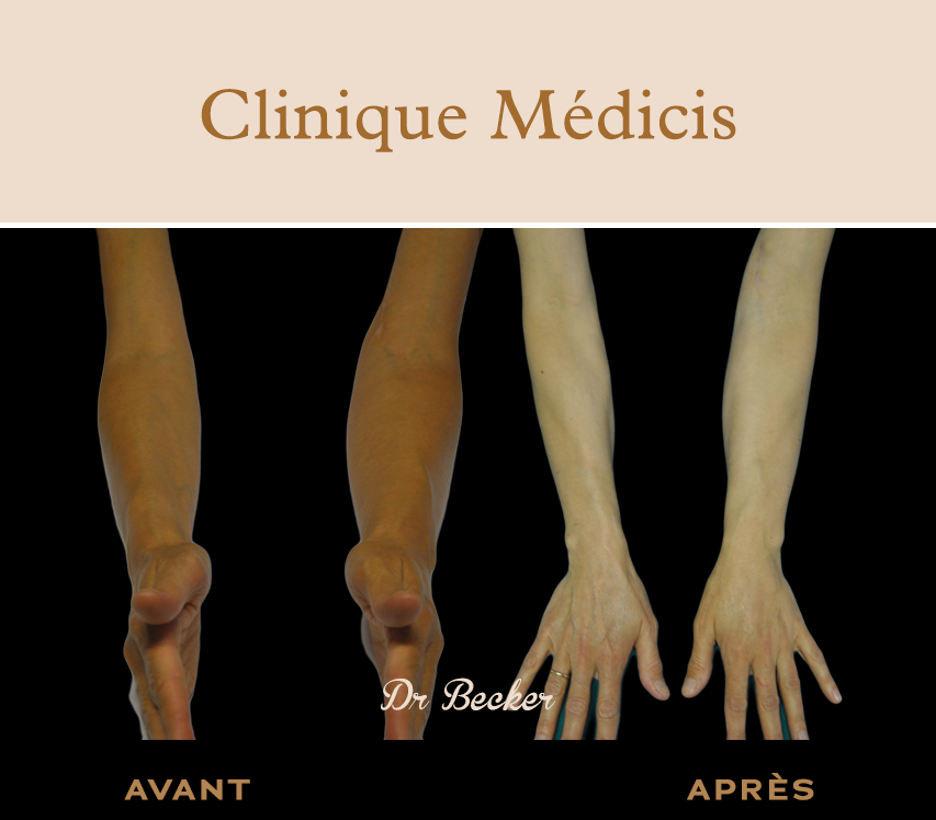 Traitement lymphœdème paris