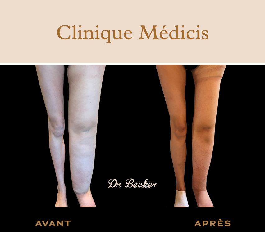 Traitement lymphœdème paris