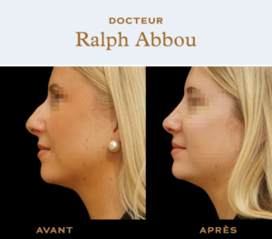 Ultrasonic rhinoplasty paris dr abbou