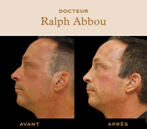 rhinoplastie ultrasonique paris