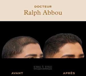 Mesotherapie des cheveux à Paris
