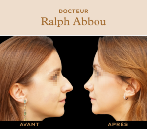 rhinoplastie ultrasonique Paris