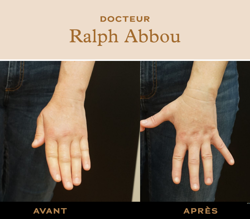 Traitement lymphœdème