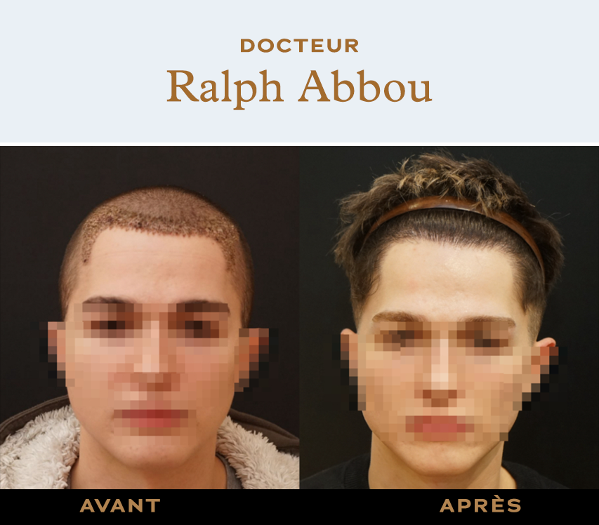 Hair transplant Paris