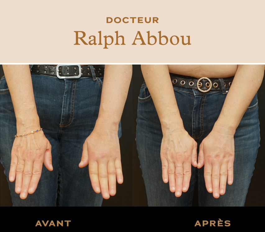 Traitement lymphœdème