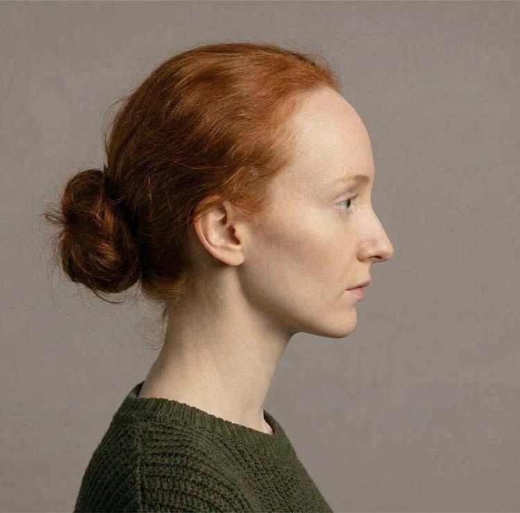 Réduction du front - Chirurgie esthétique à Paris Dr Abbou et Dr Pessis