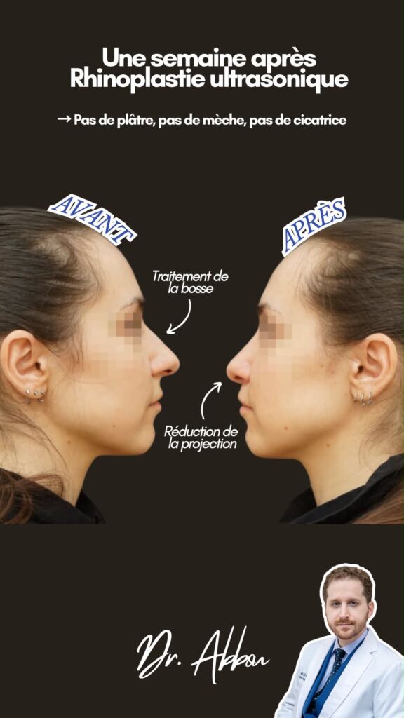 Rhinoplastie ultrasonique paris