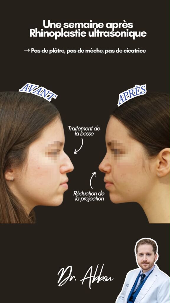 Rhinoplastie ultrasonique paris