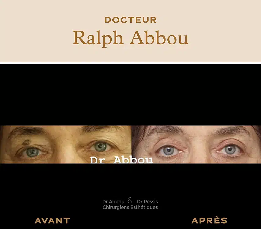 Blépharoplastie supérieure, chirurgie esthétique à Paris