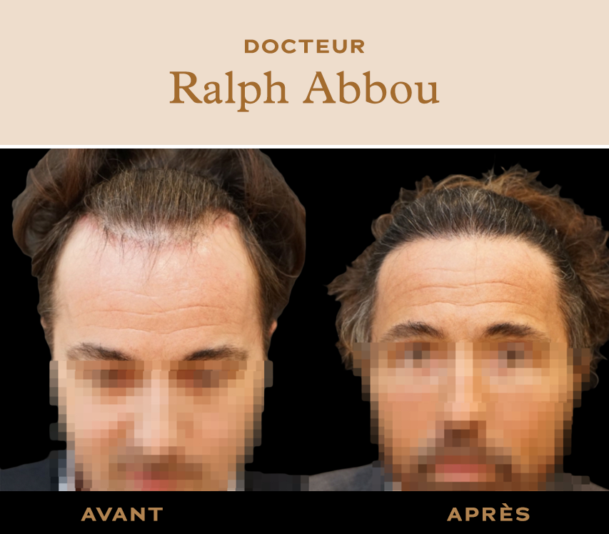 Greffe de cheveux à Paris, avant et après, vue de face, Dr Ralph Abbou