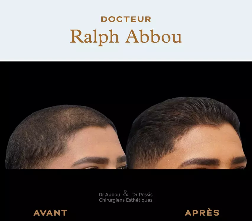 Mésothérapie capillaire à Paris pour stimuler la repousse des cheveux