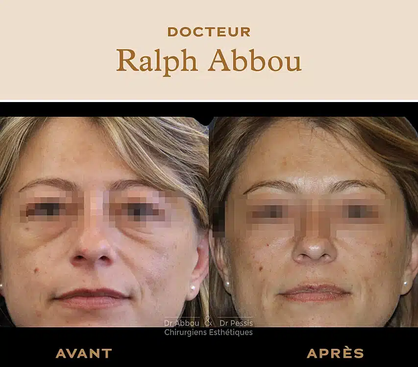 Traitement des cernes creux à Paris