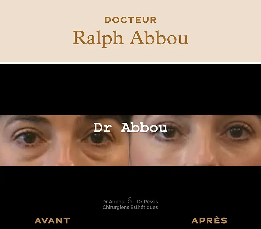 Blépharoplastie inférieure, chirurgie esthétique à Paris